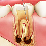 根管治療・虫歯治療