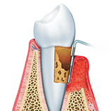 歯周病治療