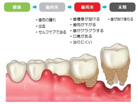 世界で1番かかる人が多い病気は歯周病？