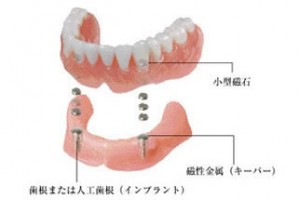 マグネット義歯