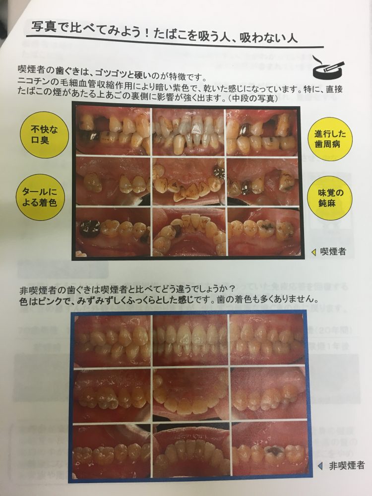 タバコと歯周病