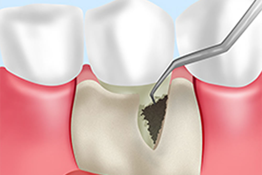 歯周外科治療
