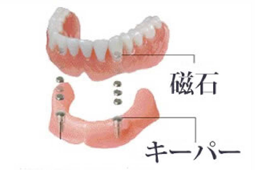 磁性アタッチメント義歯