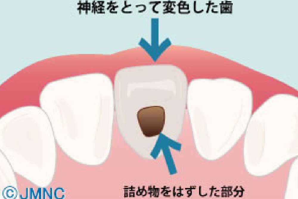 ブリーチング