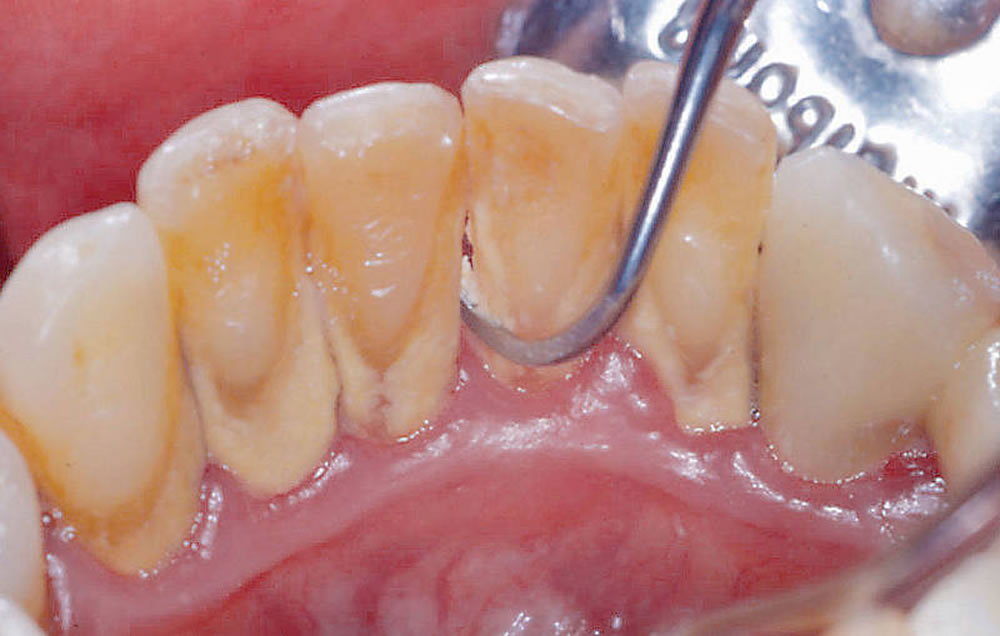 診断・歯石除去